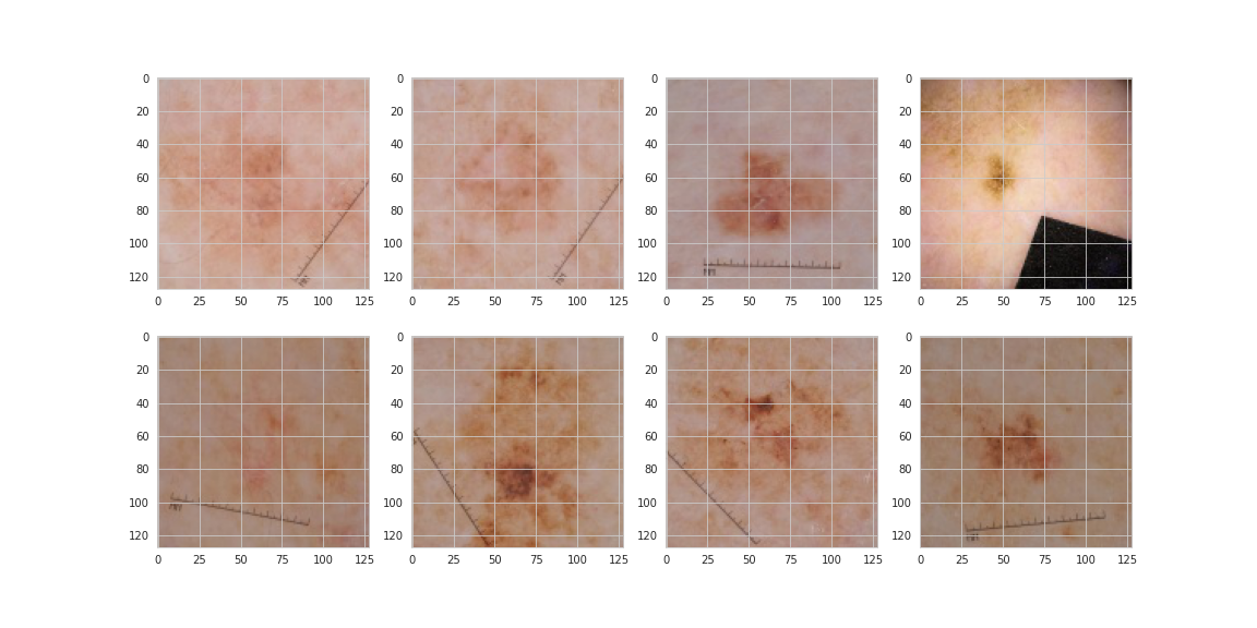 Eight malignant lesions from the same patient.